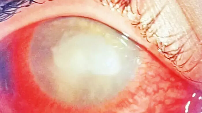 Şoke eden olay! Yüzerken çıkarmadığı lensi hayatını kabusa döndürdü - 2. Resim