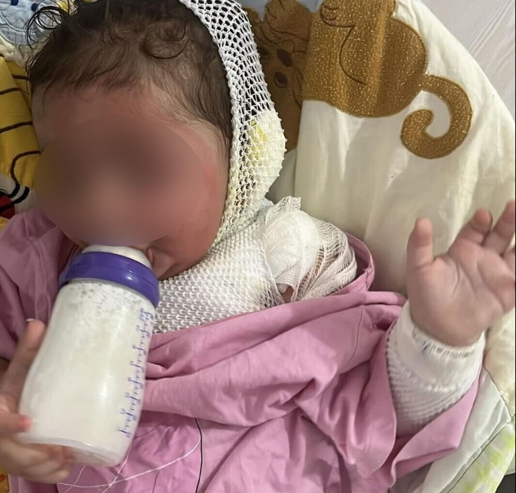 Kreşte skandal! 1.5 yaşındaki bebeği kahveyle yaktılar - 1. Resim