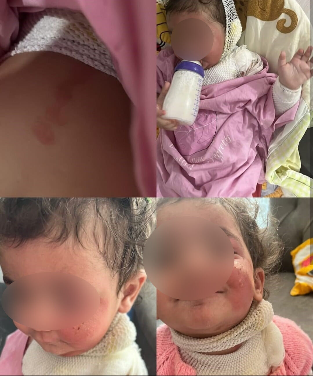 Kreşte skandal! 1.5 yaşındaki bebeği kahveyle yaktılar - 2. Resim