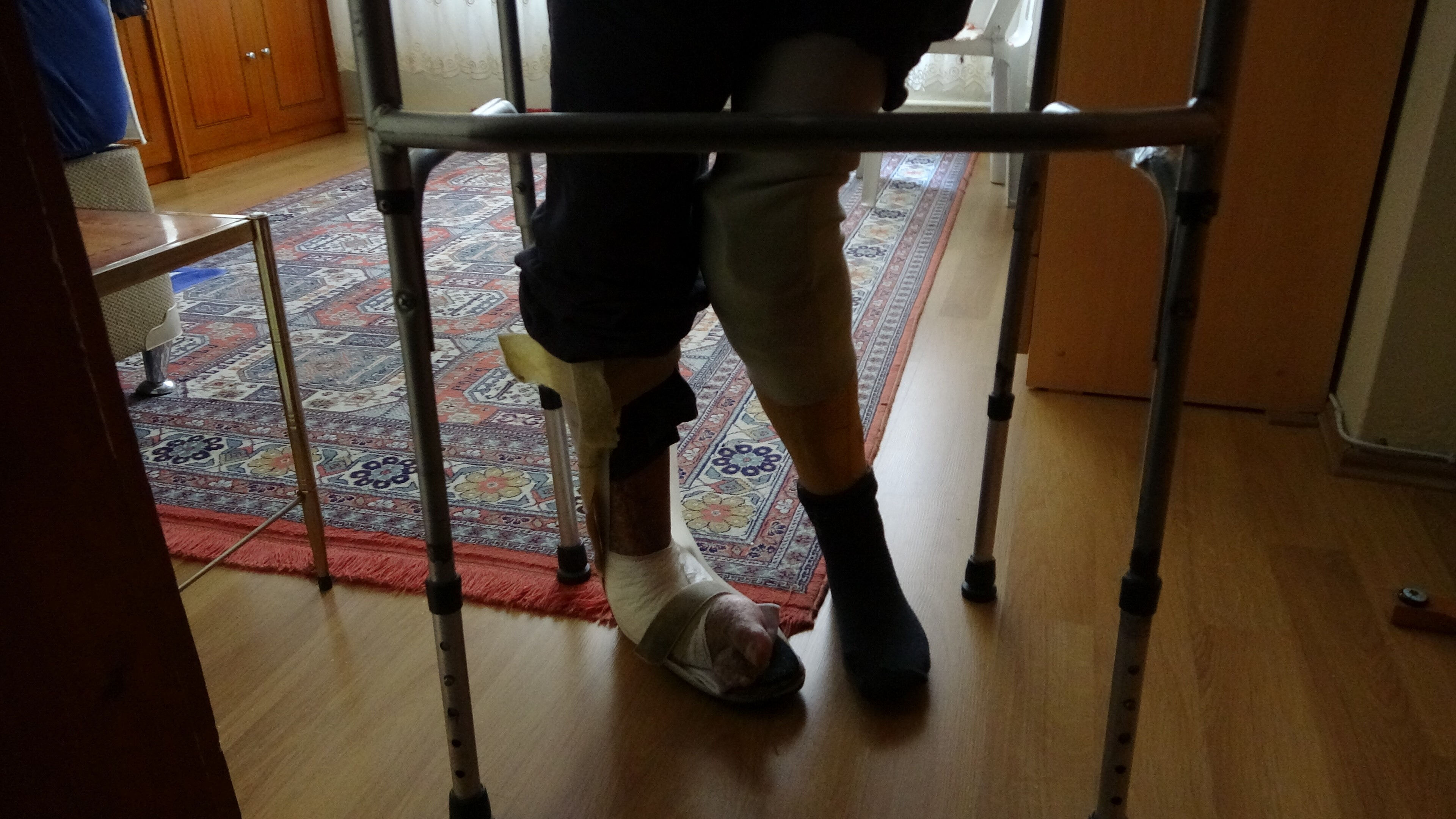 Mahallenin en hızlısıyla, bacağını kaybetti! Şeker koltuk değneğine mahkum etti - 1. Resim