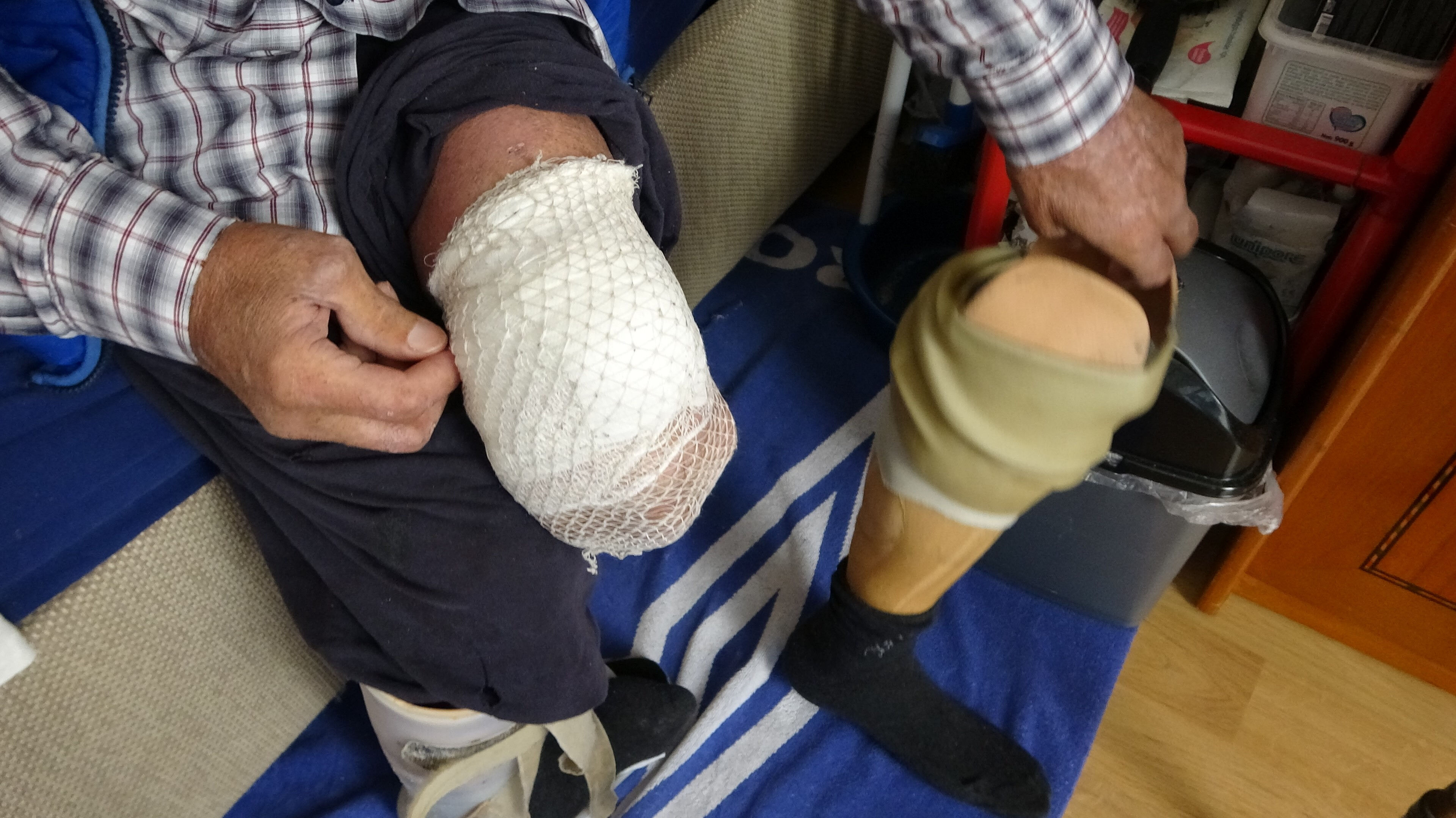 Mahallenin en hızlısıyla, bacağını kaybetti! Şeker koltuk değneğine mahkum etti - 2. Resim