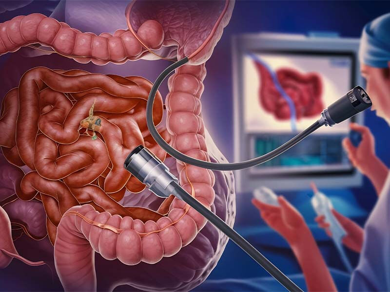 Kolonoskopi nedir? Erken teşhis için bilmeniz gerekenler Kolonoskopi nedir? Erken teşhis için bilmeniz gerekenler - 1. Resim