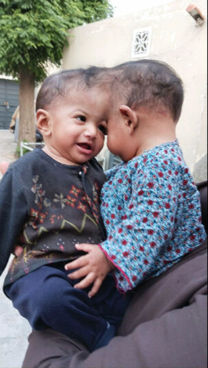 Pakistanlı yapışık ikizler Türkiye’de 14 saat süren bir operasyonla birbirinden ayrıldı - 3. Resim