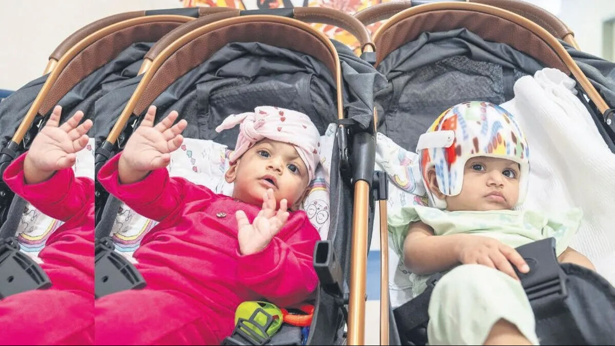 Pakistanlı yapışık ikizler Türkiye’de 14 saat süren bir operasyonla birbirinden ayrıldı - 2. Resim