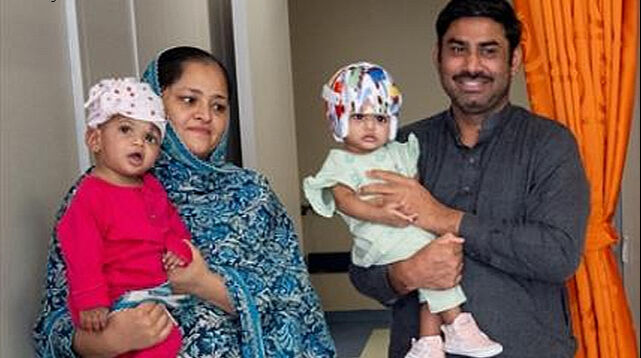 Pakistanlı yapışık ikizler Türkiye’de 14 saat süren bir operasyonla birbirinden ayrıldı - 1. Resim