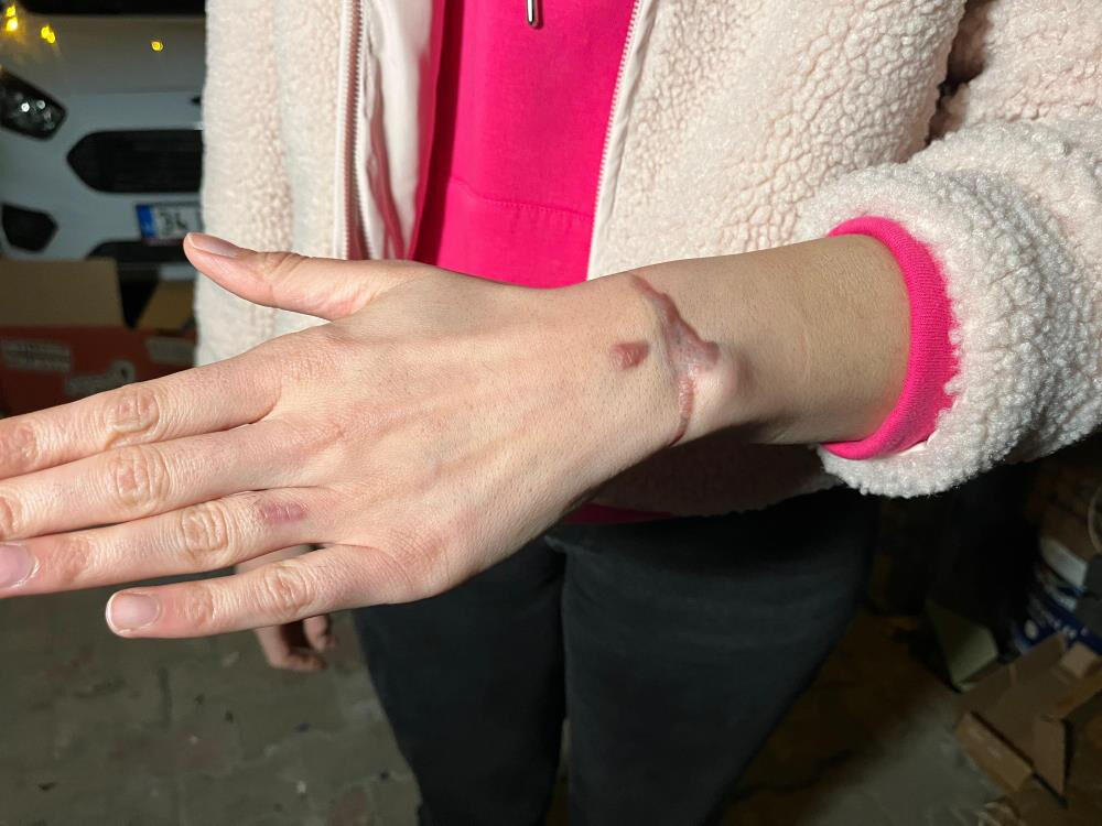 Esenyurt'ta bir güzellik merkezinde dövme sildiren kadın hastanelik oldu Esenyurt'ta bir güzellik merkezinde dövme sildiren kadın hastanelik oldu - 1. Resim