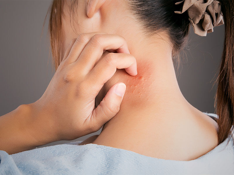 Kelebek hastalığı nedir ve belirtileri nelerdir? Kelebek hastalığı nedir ve belirtileri nelerdir? - 2. Resim