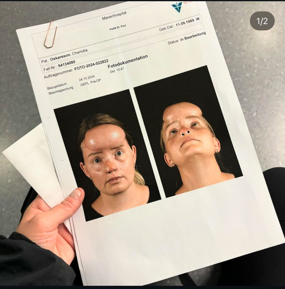 Genç kadına köpek saldırısı! Yüzünü ısırdı, burnunu kopardı - 1. Resim