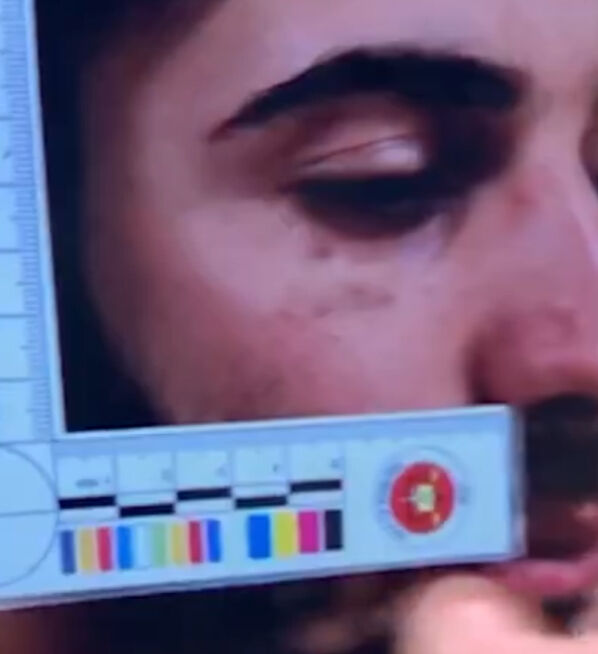 Narin Güran cinayetinde kritik gelişme! Enes Güran'ın kolundaki ısırık ve gözündeki darp izleri ilk kez yayınlandı Narin Güran cinayetinde kritik gelişme! Enes Güran'ın kolundaki ısırık ve gözündeki darp izleri ilk kez yayınlandı - 2. Resim