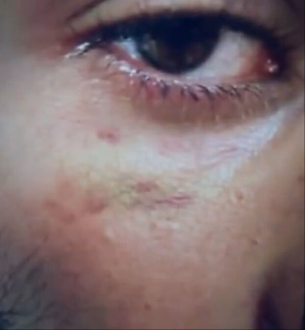 Narin Güran cinayetinde kritik gelişme! Enes Güran'ın kolundaki ısırık ve gözündeki darp izleri ilk kez yayınlandı Narin Güran cinayetinde kritik gelişme! Enes Güran'ın kolundaki ısırık ve gözündeki darp izleri ilk kez yayınlandı - 1. Resim