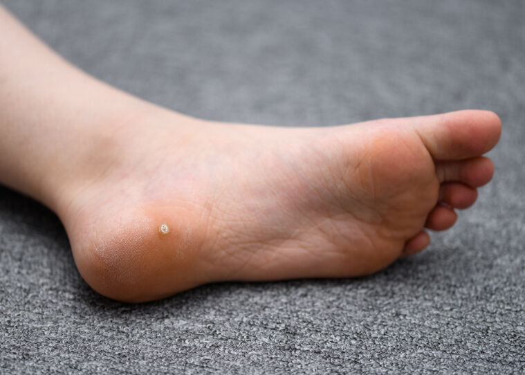 Siğil neden çıkar? Siğilin sebepleri ve çeşitleri - 1. Resim