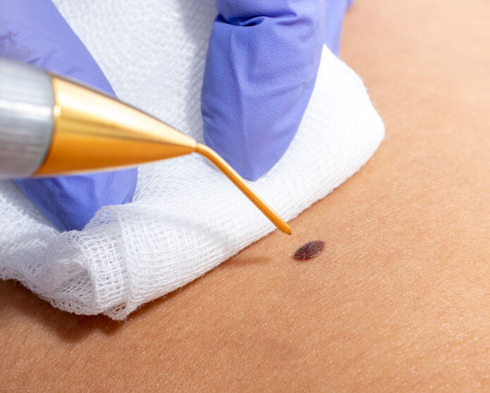 Siğil neden çıkar? Siğilin sebepleri ve çeşitleri - 4. Resim