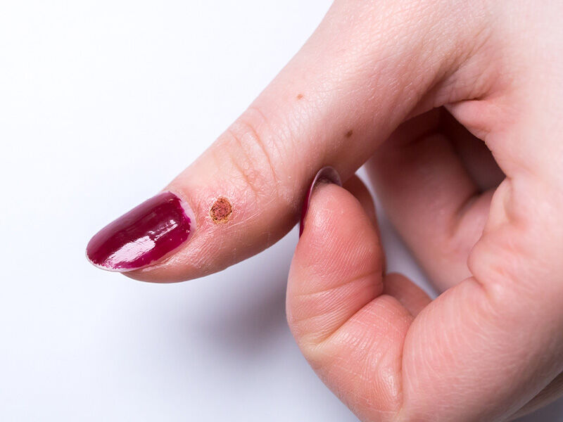 Siğil neden çıkar? Siğilin sebepleri ve çeşitleri - 2. Resim