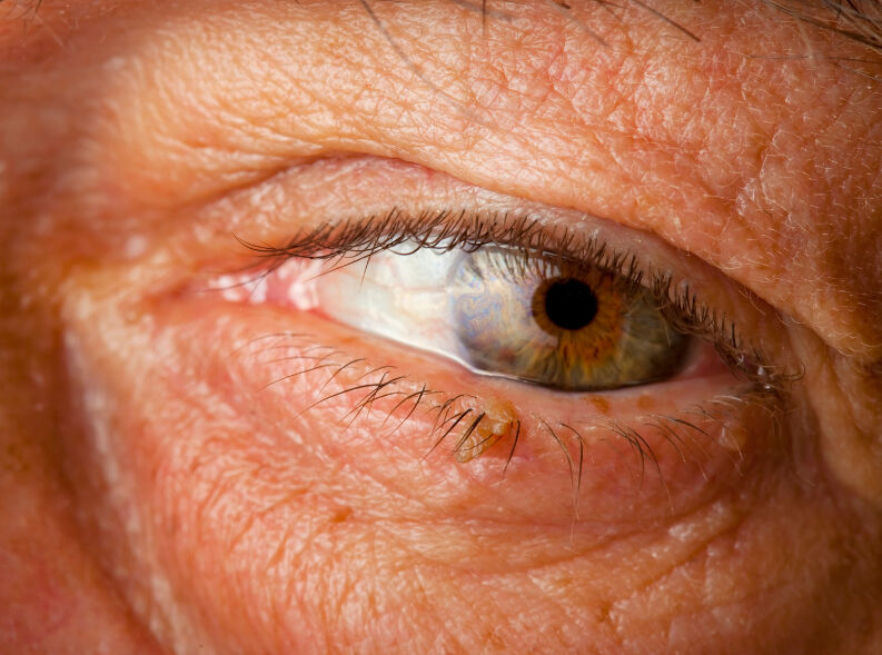 Siğil neden çıkar? Siğilin sebepleri ve çeşitleri - 3. Resim