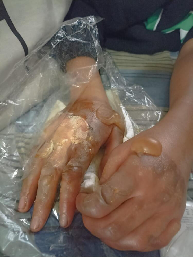 Akran zorbalığında son nokta! Çocuğu fırına sokup, yaktılar Akran zorbalığında son nokta! Çocuğu fırına sokup, yaktılar - 3. Resim