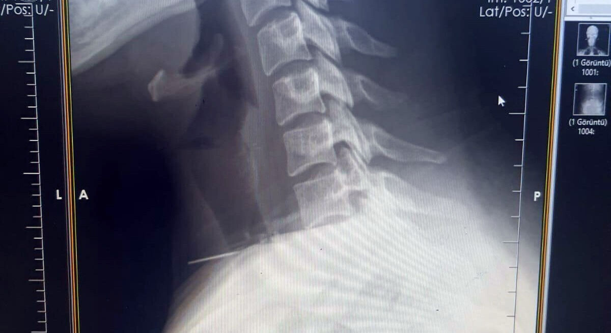 Görülmemiş kaza! Boğazına saplanan iğne ameliyatla çıkarıldı - 1. Resim