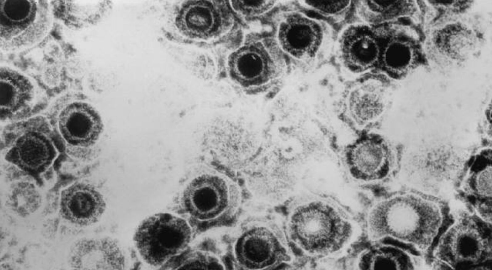 HSV-2 nedir, nasıl bulaşır, ölümcül mü? Dünya Sağlık Örgütü Herpes virüsü için uyarıda bulundu! - 5. Resim