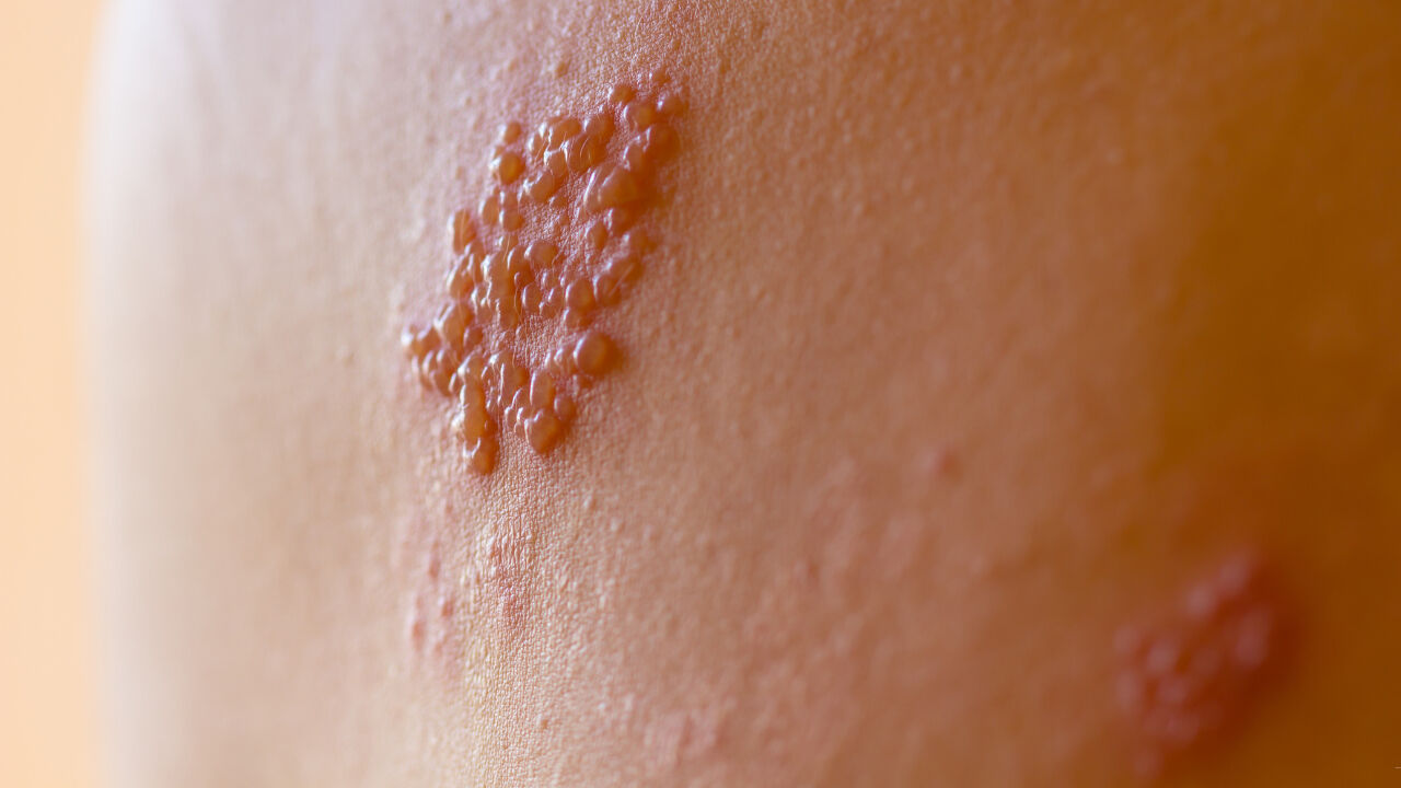 HSV-2 nedir, nasıl bulaşır, ölümcül mü? Dünya Sağlık Örgütü Herpes virüsü için uyarıda bulundu! - 4. Resim