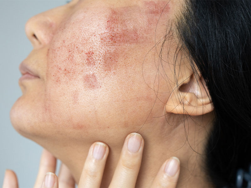 Kelebek hastalığı nedir? - 1. Resim