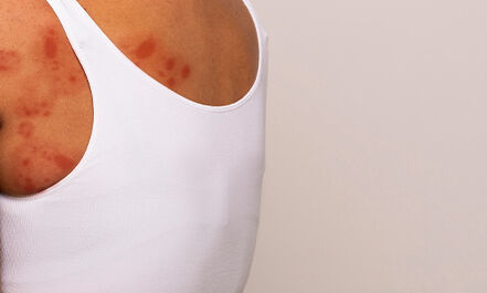 Kelebek hastalığı nedir? - 3. Resim