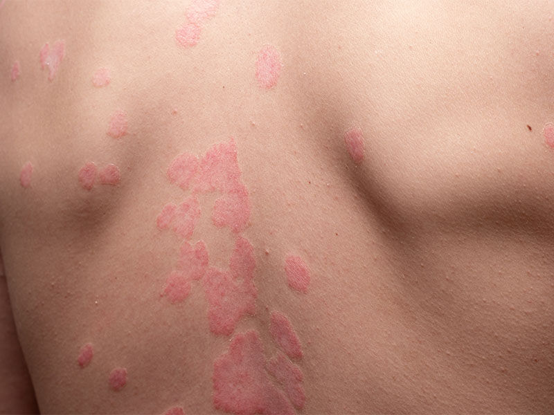 Kelebek hastalığı nedir? - 4. Resim