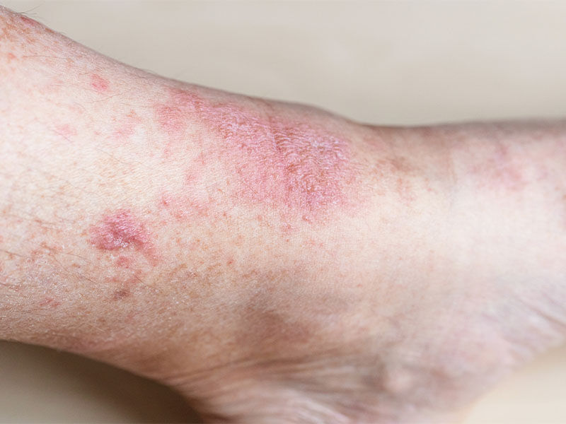 Kelebek hastalığı nedir? - 2. Resim