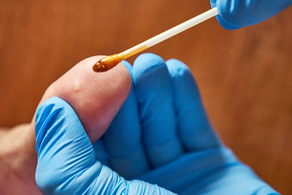 Siğil nasıl geçer? Türleri ve tedavi yöntemleri Siğil nasıl geçer? Türleri ve tedavi yöntemleri - 2. Resim