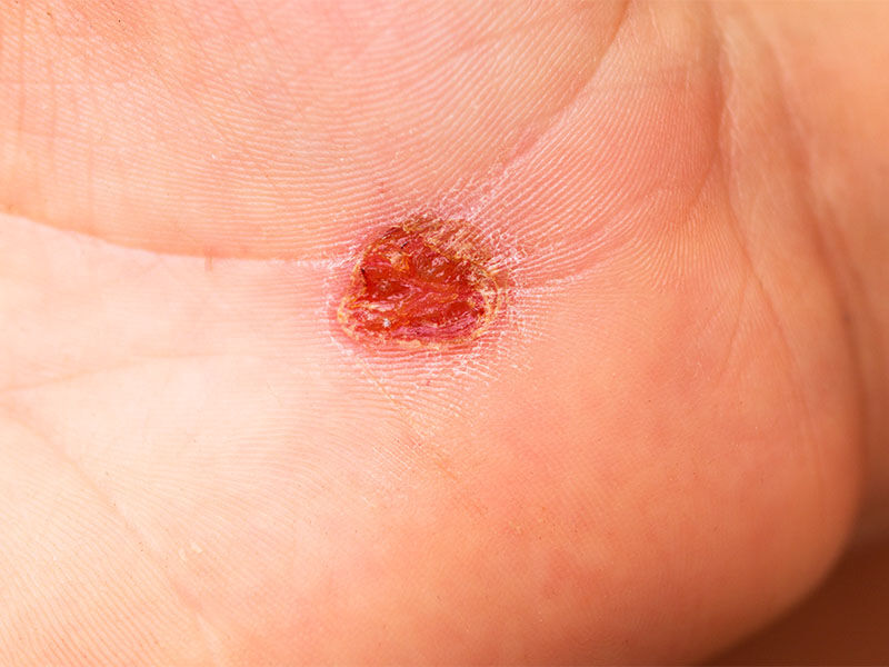 Siğil nasıl geçer? Türleri ve tedavi yöntemleri Siğil nasıl geçer? Türleri ve tedavi yöntemleri - 1. Resim