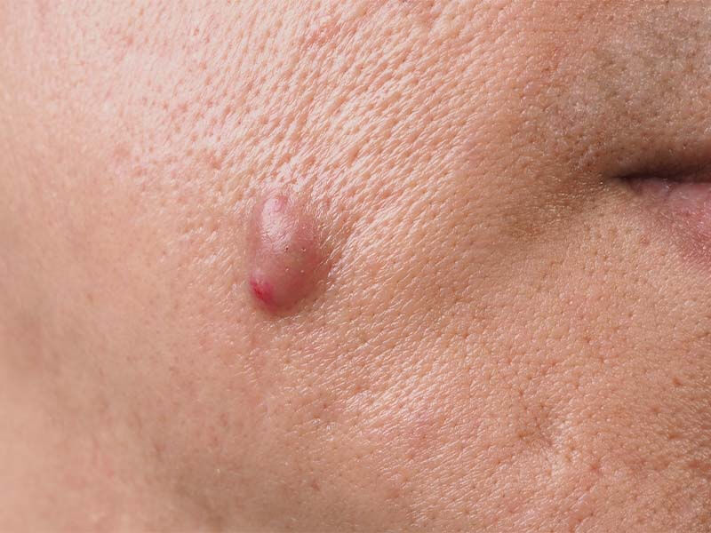 Siğil nasıl geçer? Türleri ve tedavi yöntemleri Siğil nasıl geçer? Türleri ve tedavi yöntemleri - 4. Resim