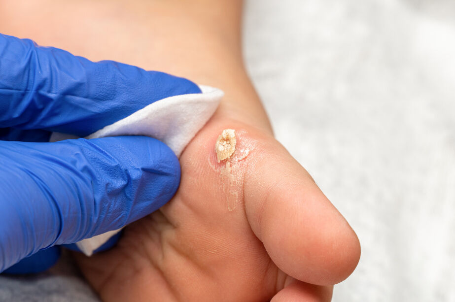 Siğil nasıl geçer? Türleri ve tedavi yöntemleri Siğil nasıl geçer? Türleri ve tedavi yöntemleri - 3. Resim