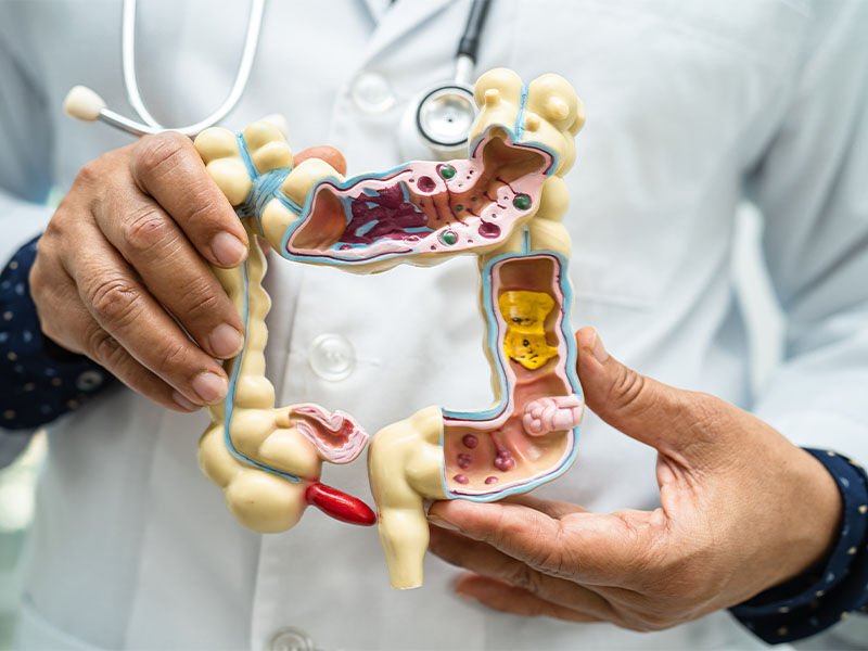 Bağırsak kanseri belirtileri nelerdir? Türkiye'de en yaygın üçüncü tür hakkında bilmeniz gerekenler - 3. Resim