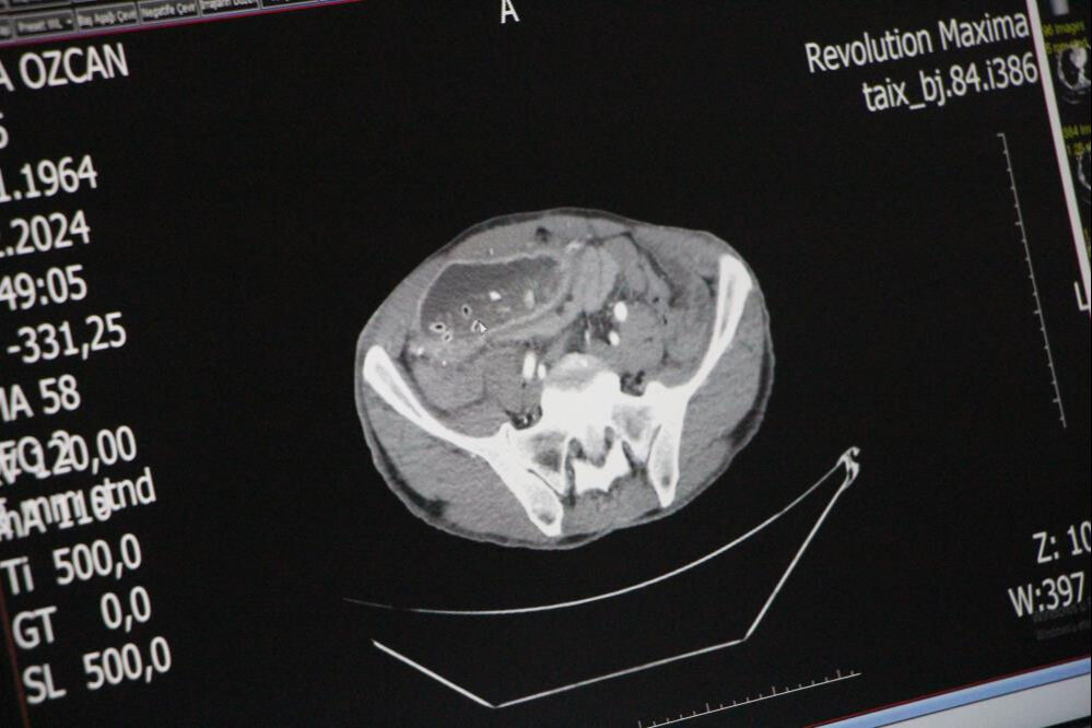 Yemek yedikten sonra kusa adamın midesi 20 yıllık uzmanı şoke etti: Hamile kadın gibi - 3. Resim