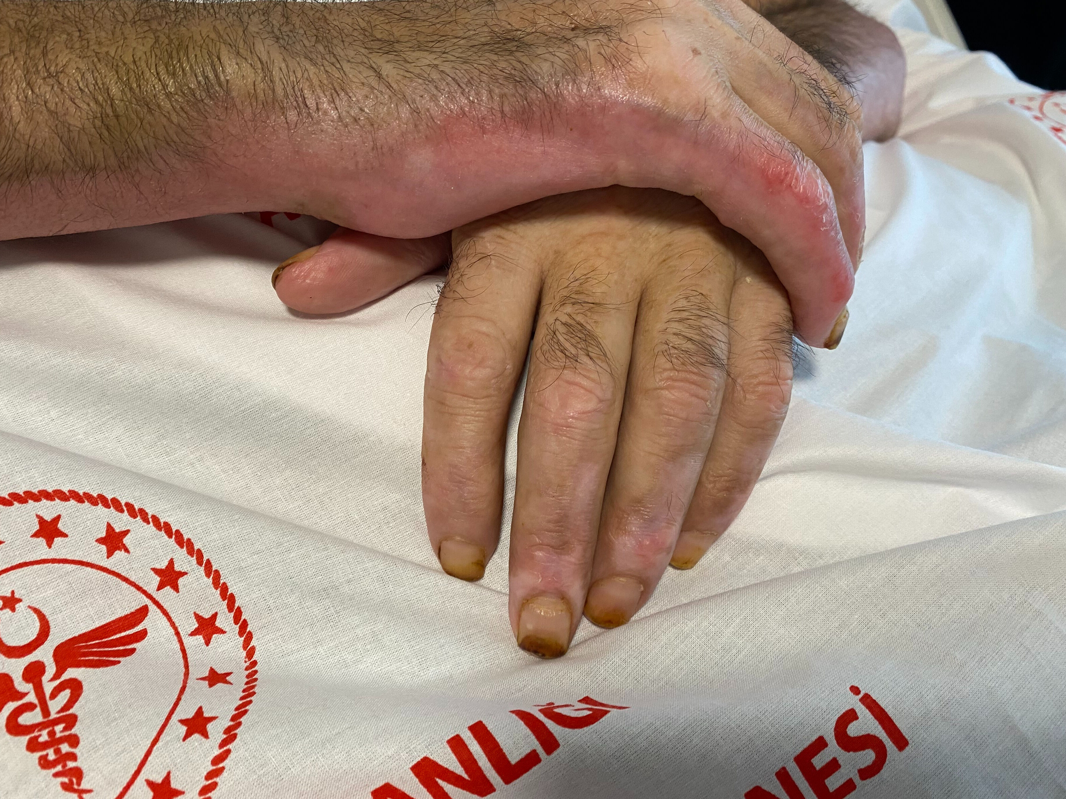 Patlama yeri göğü inletti! Saniyeler içinde vücudunun yüzde 80'i yandı: Bunu yaparken dikkat edin - 4. Resim