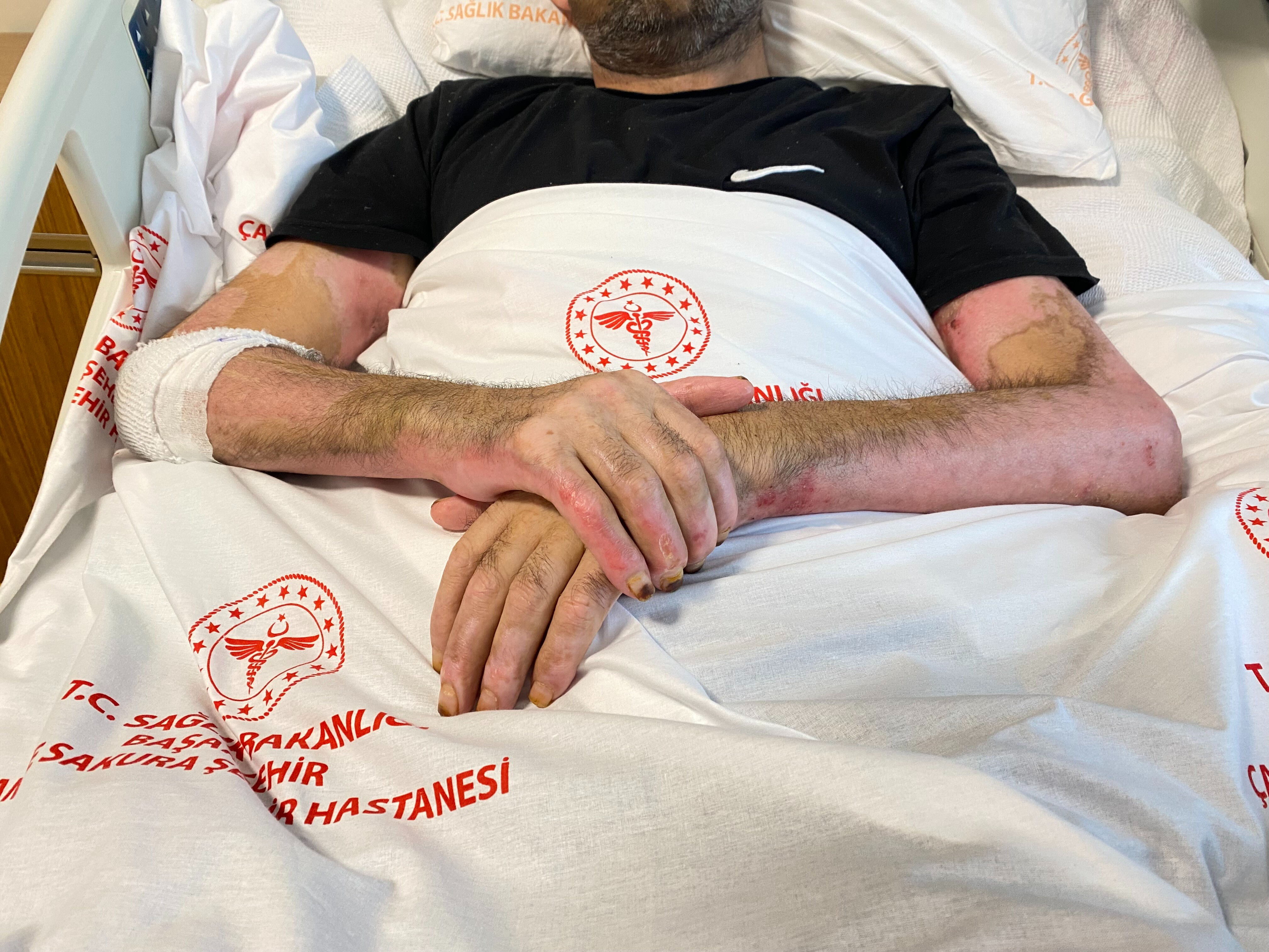 Patlama yeri göğü inletti! Saniyeler içinde vücudunun yüzde 80'i yandı: Bunu yaparken dikkat edin - 2. Resim