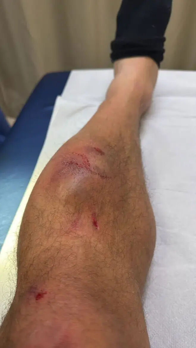 Bacağının halini görenler şoke oldu! Emre Belözoğlu'ndan yeni paylaşım - 2. Resim