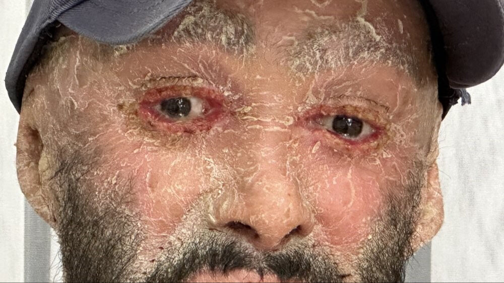 Sadece iğneleri 42 bin lira! Derisi pul pul dökülen Hakkarili 'iktiyozis' hastası tedaviye cevap verdi Sadece iğneleri 42 bin lira! Derisi pul pul dökülen Hakkarili 'iktiyozis' hastası tedaviye cevap verdi - 3. Resim