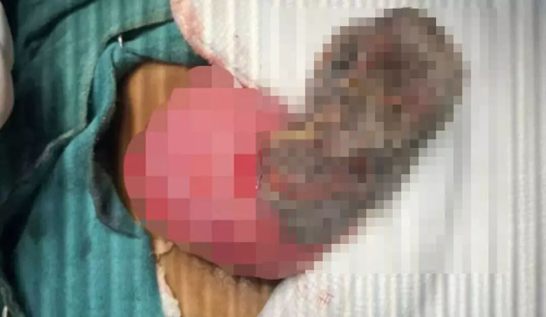 4 yaşındaki kızın midesinden çıktı! Doktorlar bile inanamadı: "Kuyruğu var" 4 yaşındaki kızın midesinden çıktı! Doktorlar bile inanamadı: "Kuyruğu var" - 1. Resim