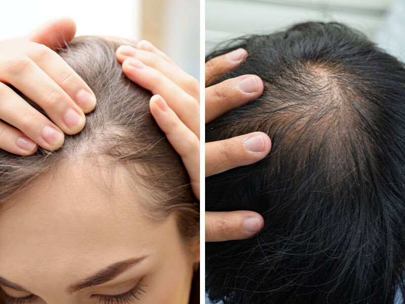 13 yaşından beri saçlarını koparıp yiyen kız: Çok fazla 'saç yolma hastası'yla tanıştım, grubumuz var! - 3. Resim