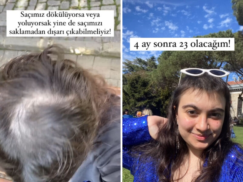 13 yaşından beri saçlarını koparıp yiyen kız: Çok fazla 'saç yolma hastası'yla tanıştım, grubumuz var! - 1. Resim