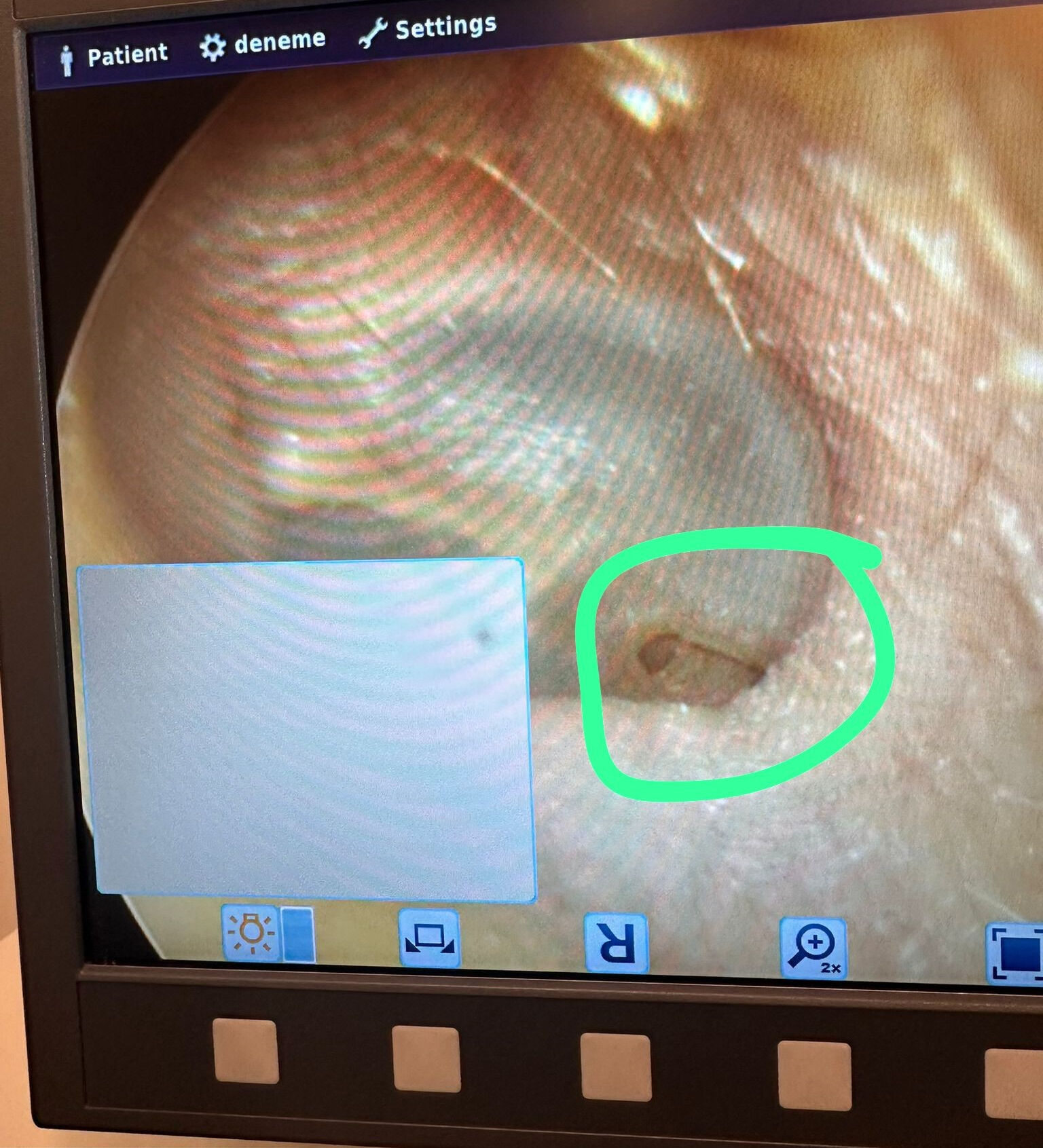 Saç ektirmek istedi, hayatı altüst oldu! "Tedavisi yok, bununla yaşamayı öğren" dediler... Saç ektirmek istedi, hayatı altüst oldu! "Tedavisi yok, bununla yaşamayı öğren" dediler... - 2. Resim