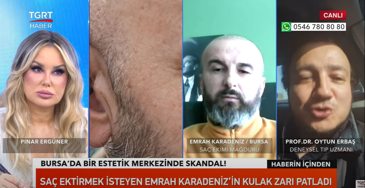 Kafasına saç ektirmek istemişti! Başına saçtan başka her şey geldi! O zorlu süreci TGRT Haber'e anlattı - 4. Resim