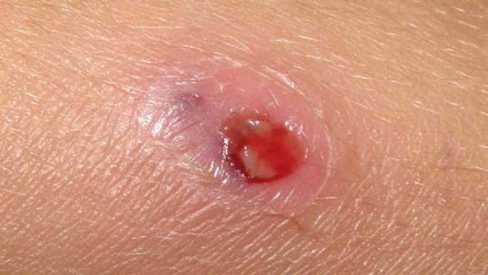 Öpücük Böceği: Chagas hastalığı nedir, belirtileri nelerdir? İşte Türkiye'deki riskler! Öpücük Böceği: Chagas hastalığı ve Türkiye'deki riskler! - 4. Resim