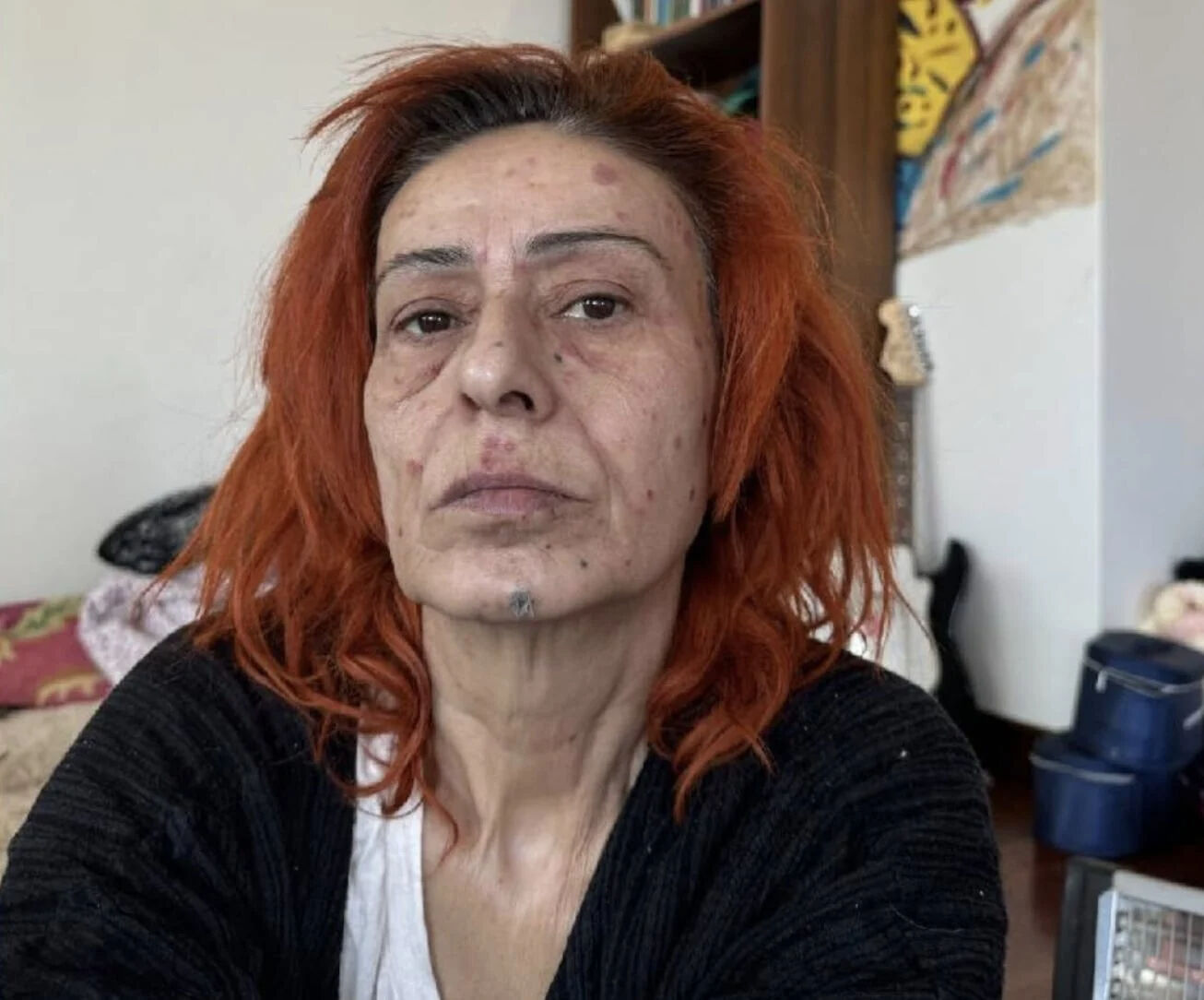 Ünlü şarkıcı Yıldız Tilbe'nin yüzü yandı! Son hali görenleri korkuttu Ünlü şarkıcı Yıldız Tilbe'nin yüzü yandı! Son hali görenleri korkuttu - 3. Resim