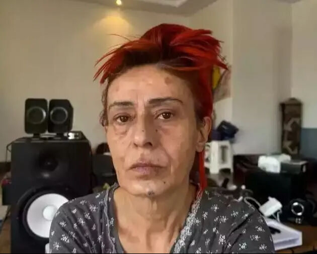 Ünlü şarkıcı Yıldız Tilbe'nin yüzü yandı! Son hali görenleri korkuttu Ünlü şarkıcı Yıldız Tilbe'nin yüzü yandı! Son hali görenleri korkuttu - 4. Resim