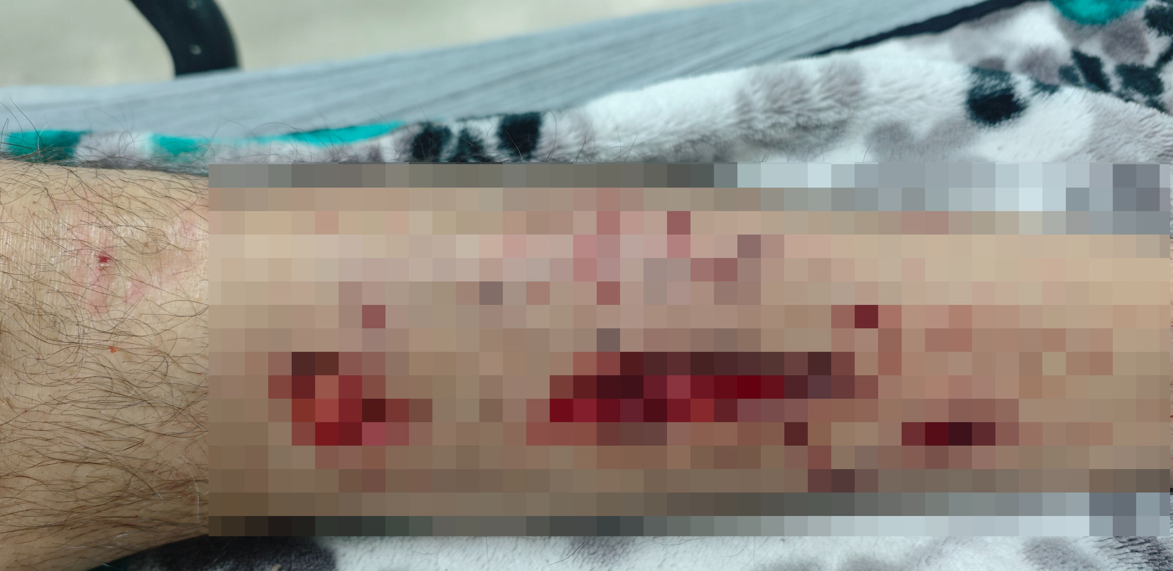 Alzheimer adam dehşeti yaşadı! Başıboş köpekler saldırdı, tam 25 yerinden ısırıldı - 1. Resim