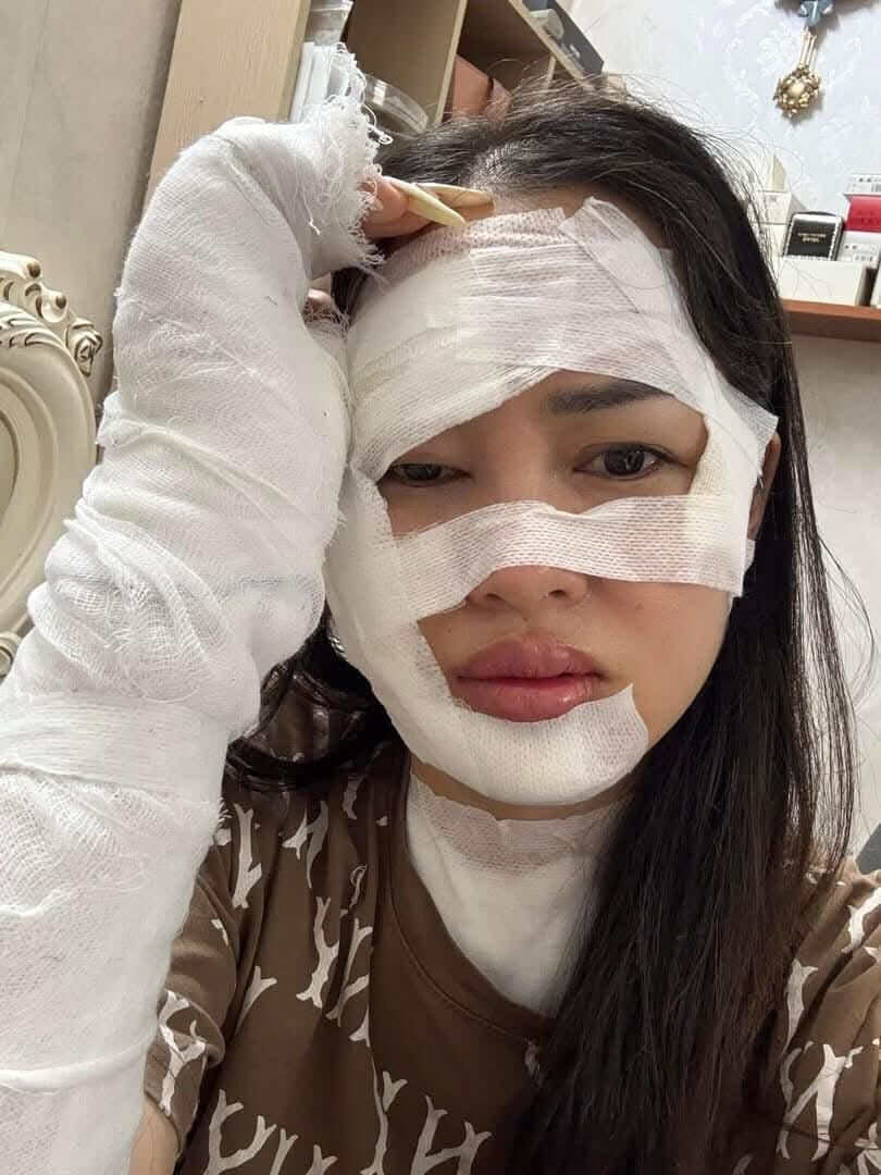 Doğum gününde balon faciası! Elinde patlayınca yüzünü yaktı Doğum gününde balın faciası! Elinde patlayınca yüzünü yaktı - 1. Resim