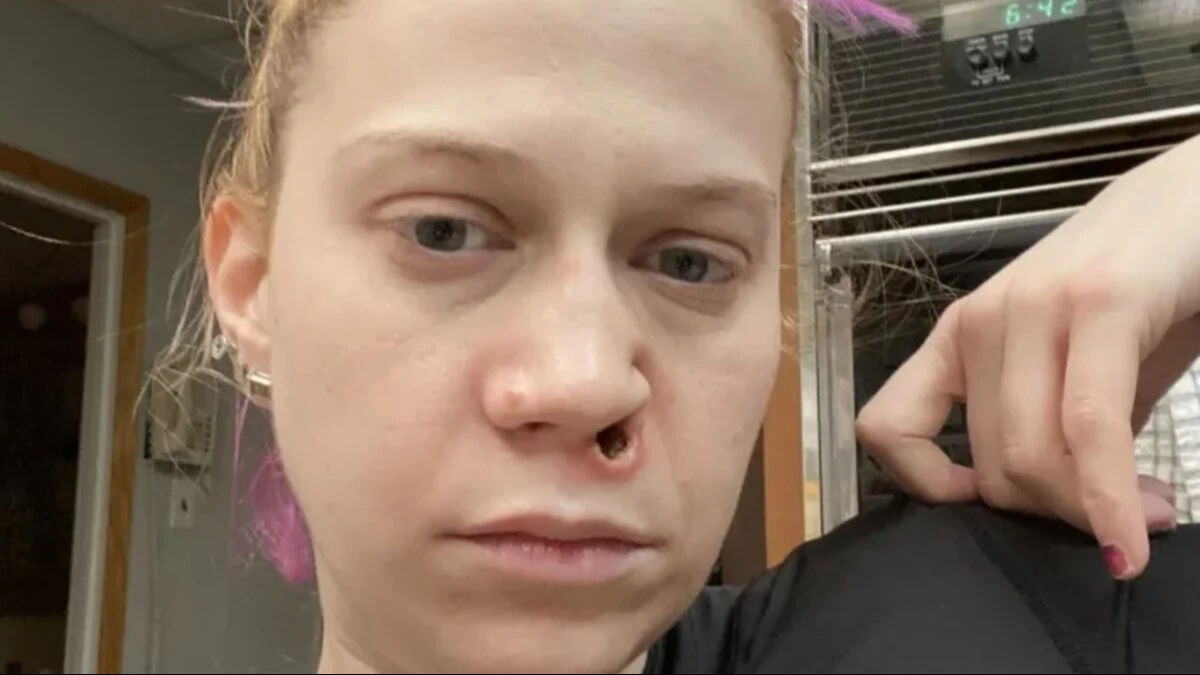 Uyuşturucu burnunu eritti! 15 operasyon geçirmek zorunda kaldı  - 1. Resim