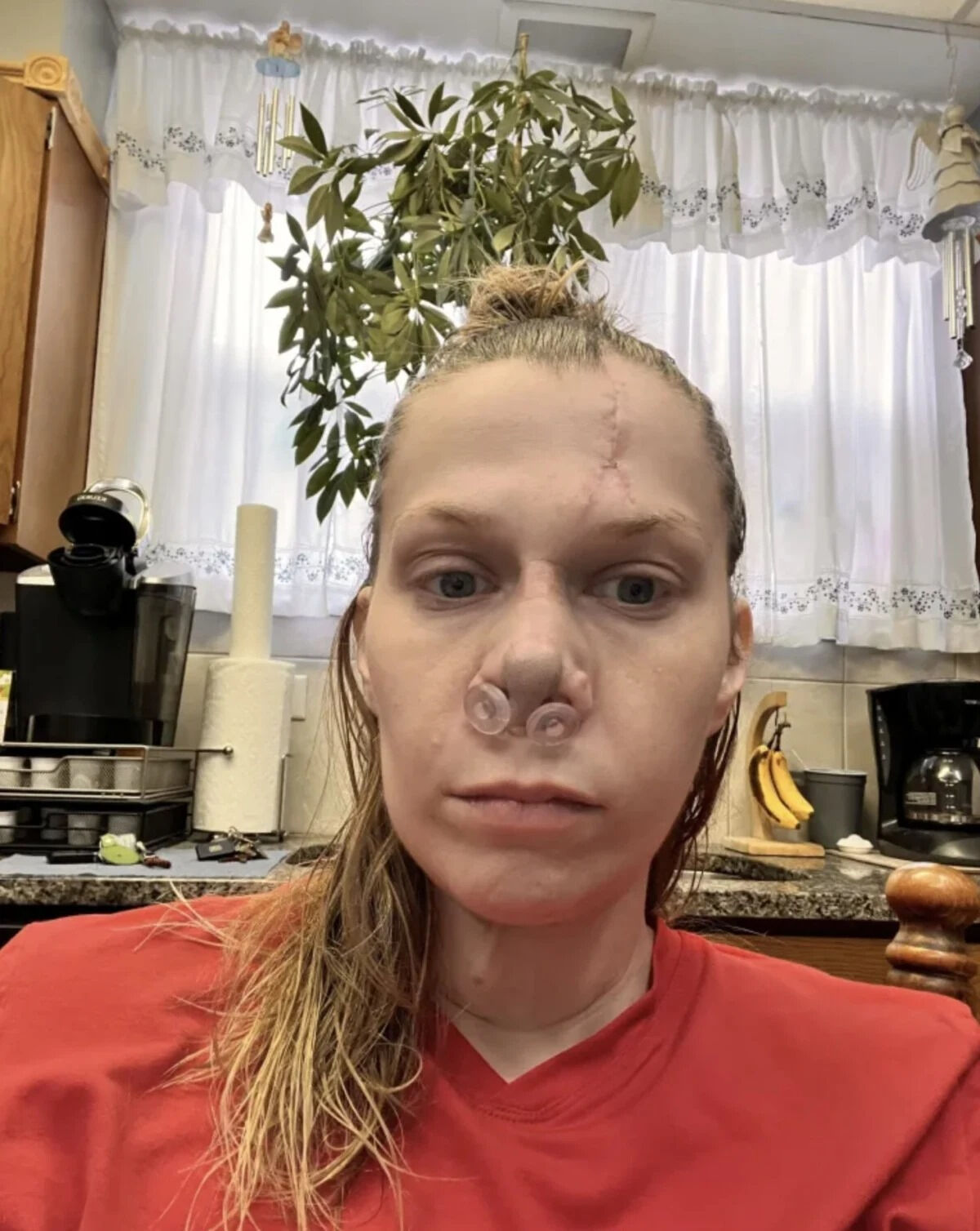 Uyuşturucu burnunu eritti! 15 operasyon geçirmek zorunda kaldı  - 2. Resim