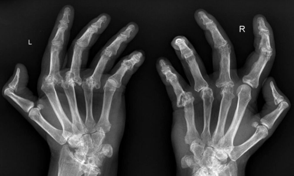 Romatizma ve eklem ağrılarının sırrı - 5. Resim