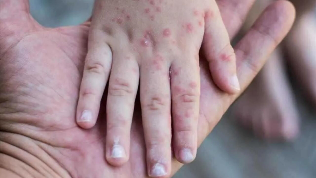 ABD'de salgın yayılıyor, ölümler arttı! 12 eyalette kızamık alarmı - 1. Resim